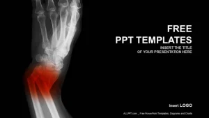 Broken Forearm-Medical PowerPoint Templates